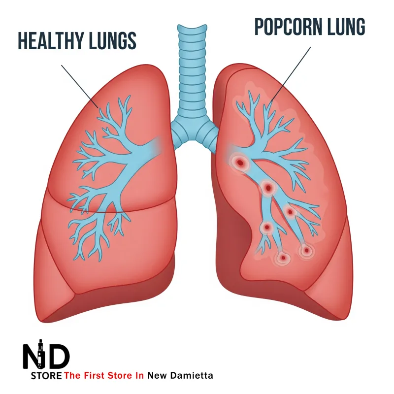popcorn lung توضيح مبسط لفكرة Popcorn Lungs المرتبطة بالفيب - ND Store - أفضل فيب ستور في دمياط