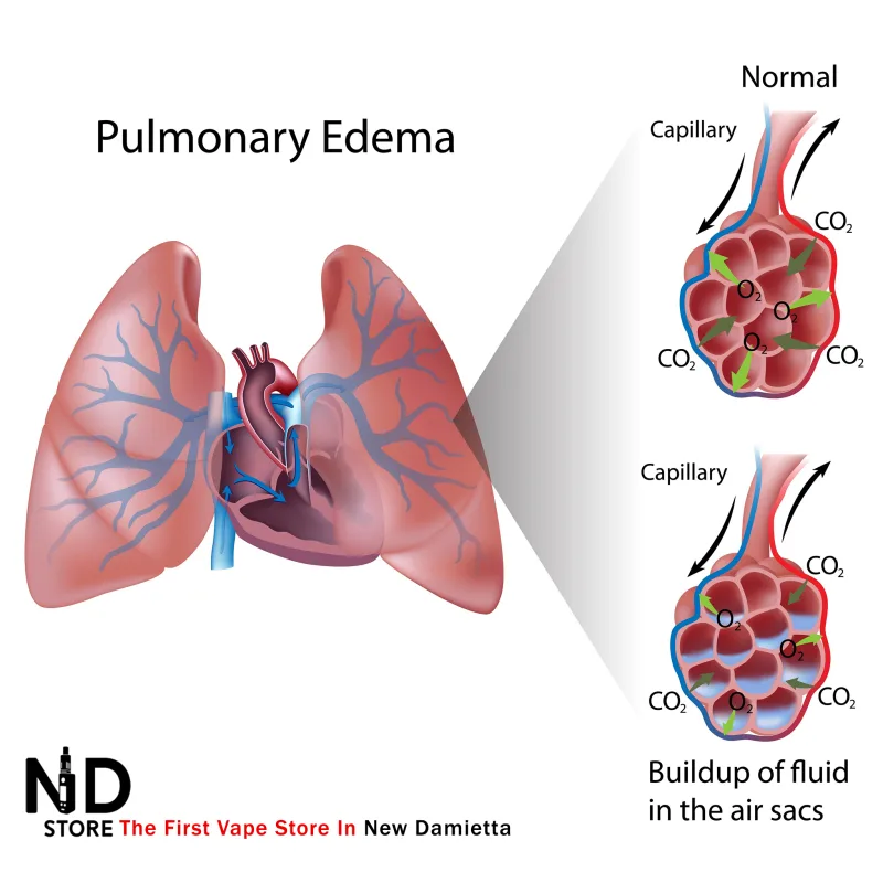 المية على الرئة Pulmonary Edema تجمع السوائل داخل الحويصلات الهوائية